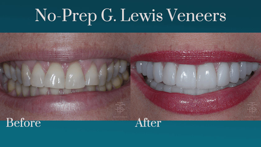 before and after veneers