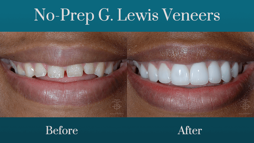 no-prep G.Lewis Veneers before