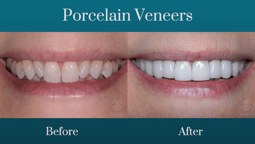 Porcelain veneers before and a