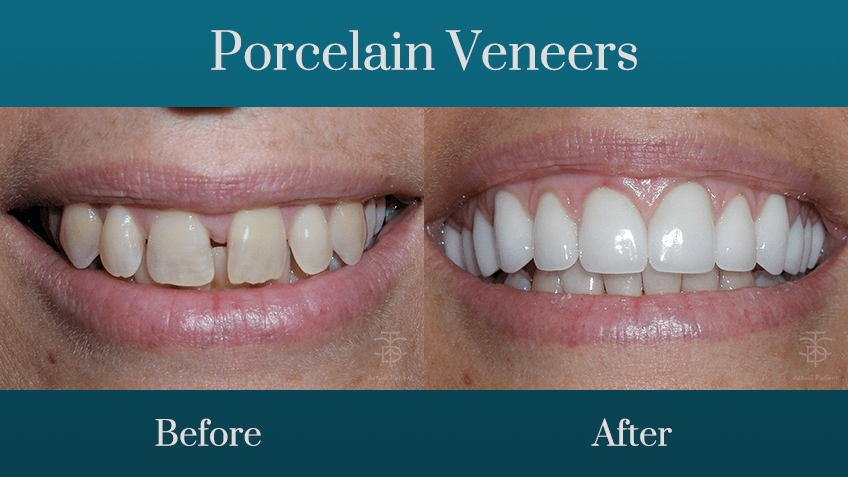 porcelain veneers before and a