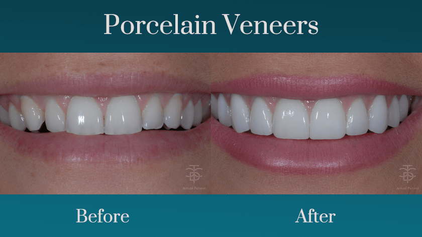 porcelain veneers patient befo