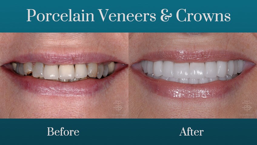 before and after smile transfo