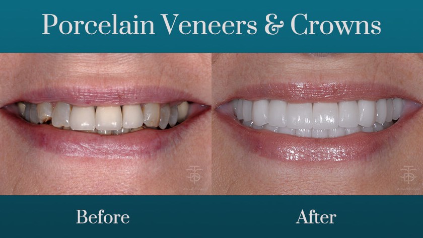 porcelain veneers and crowns b