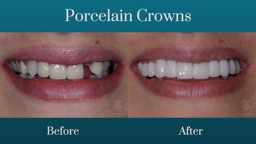 before and after crowns
