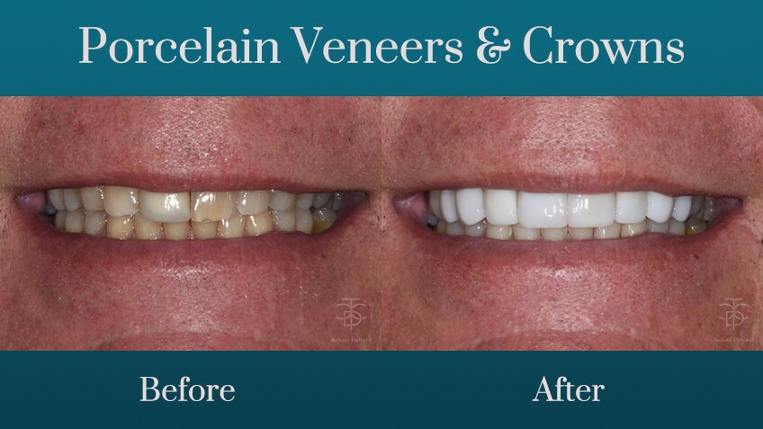 before and after smile makeove