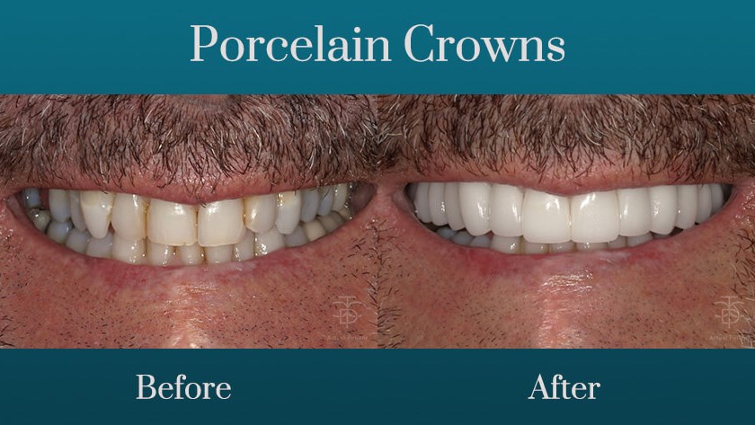 porcelain-crowns-smile-makeove