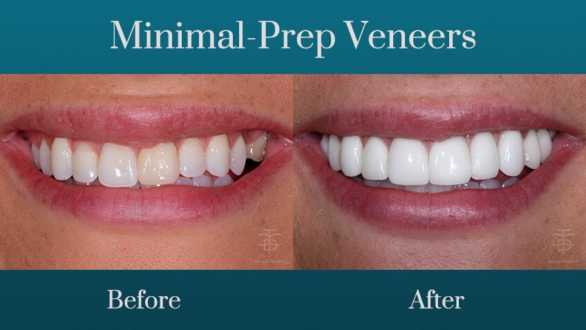 minimal-prep-veneers-smile-mak