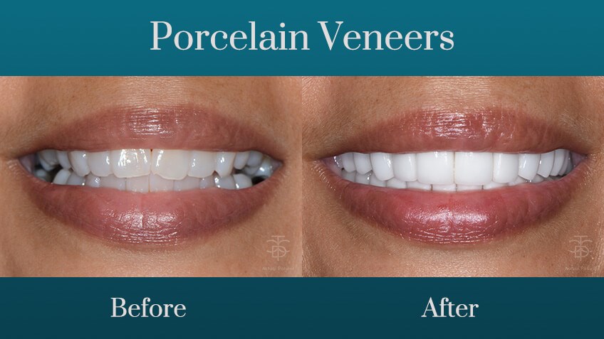 porcelain-veneers-before-and-a