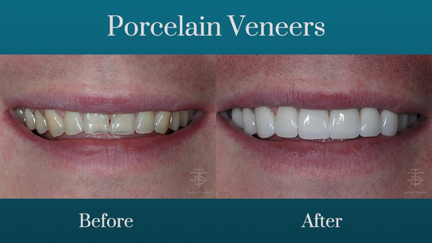 full-porcelain-veneers