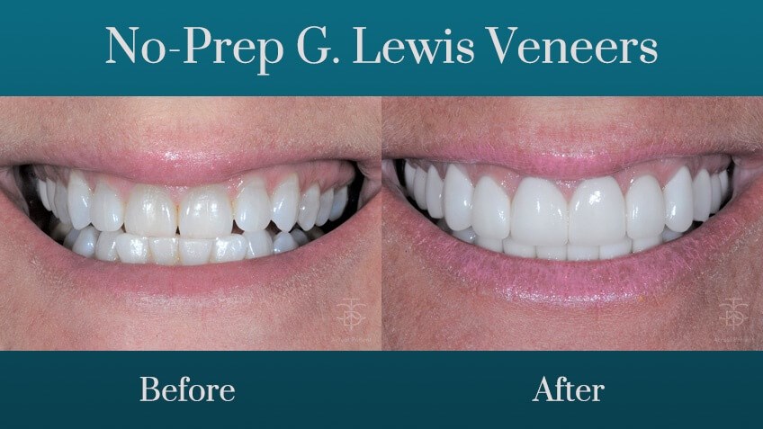 before and after no-prep-g-lew