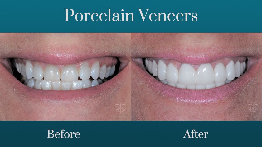 porcelain veneers