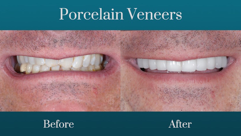 porcelain veneers