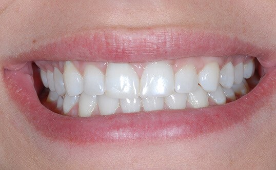 No Prep G Lewis Veneers and Gum Contouring for Female Patient