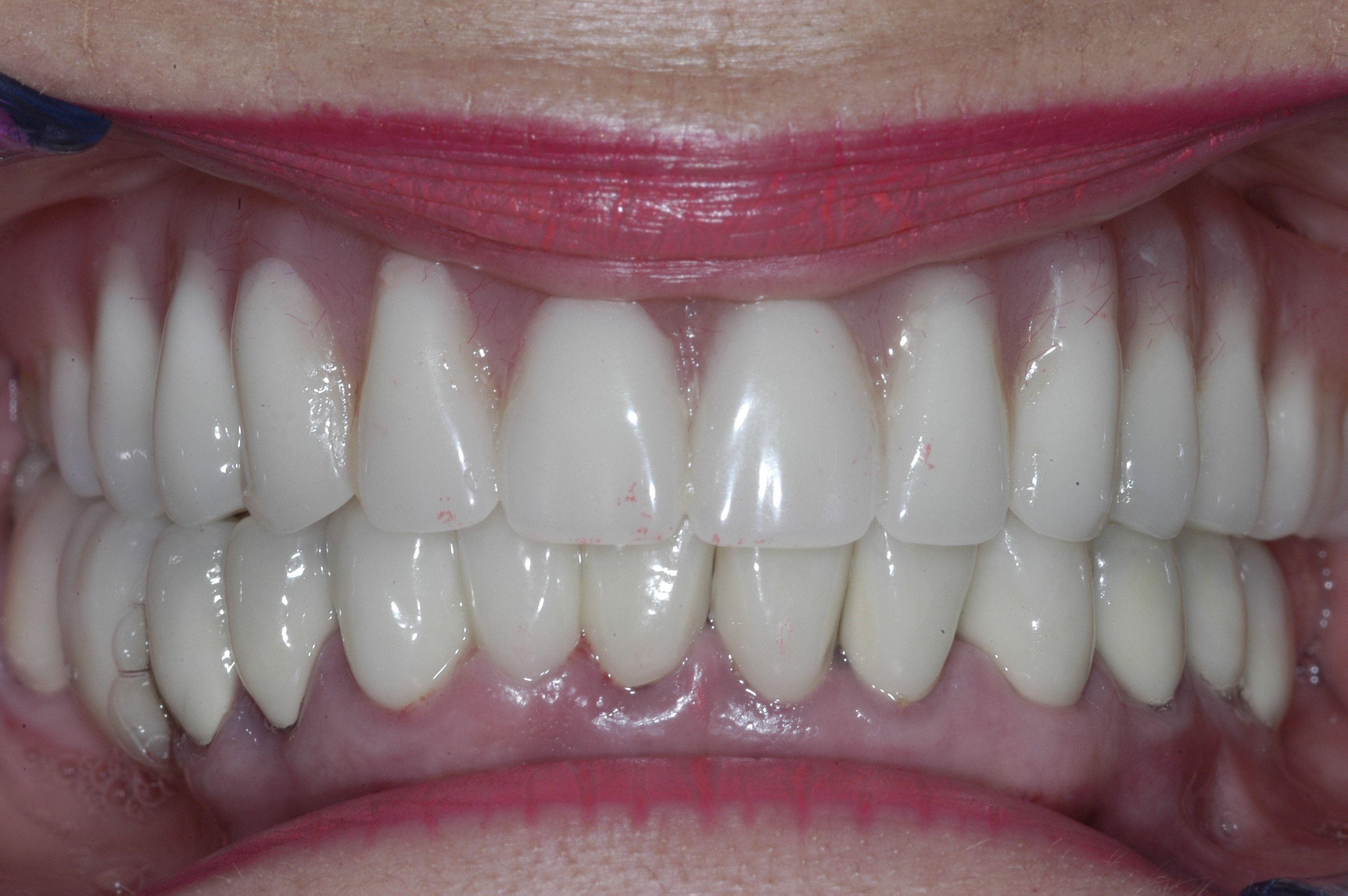 Implant Supported Dentures for Female Patient in The Woodlands, TX Implant Supported Dentures for Female Patient in The Woodlands, TX