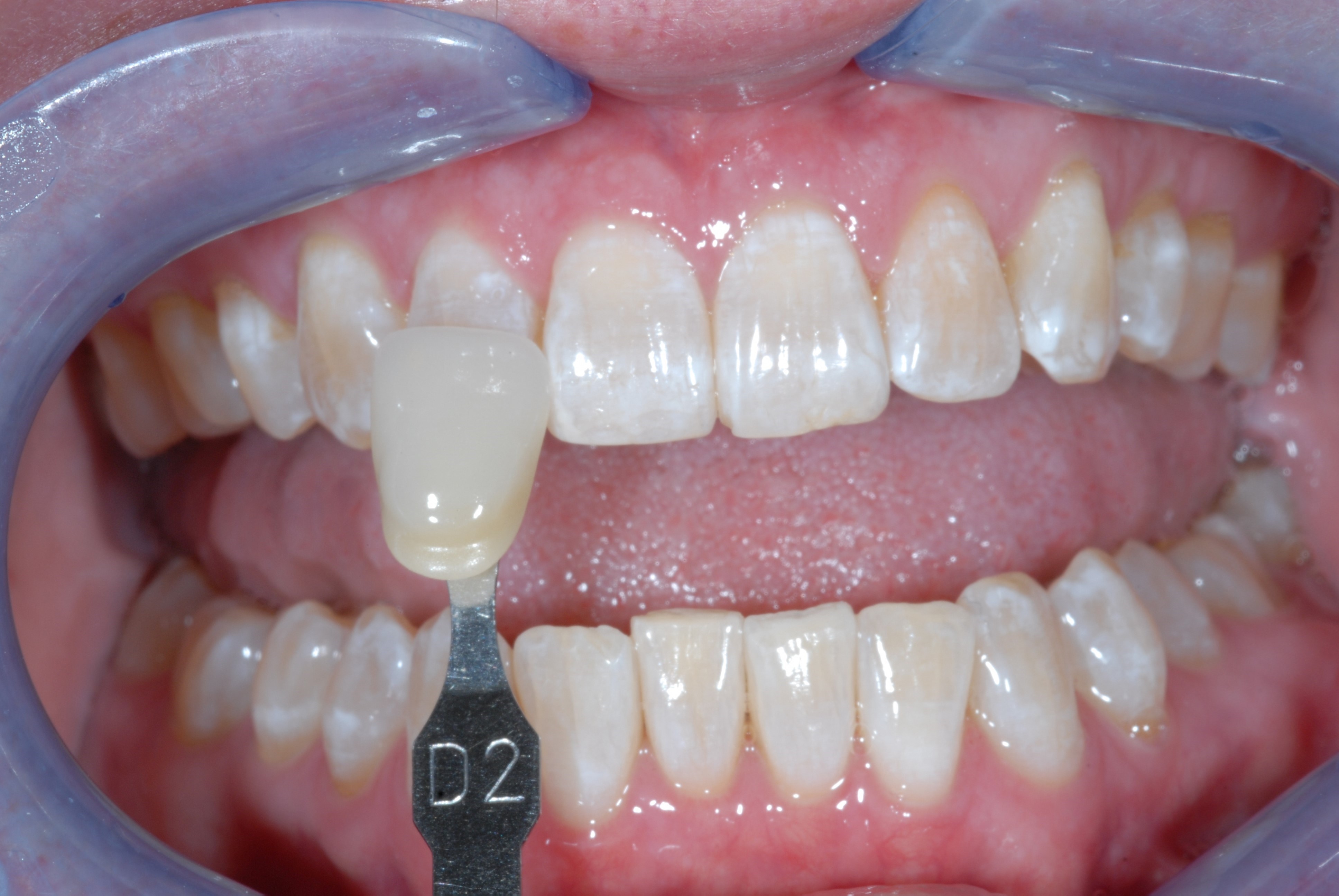 Before and After ZOOM!® Teeth Whitening Photos