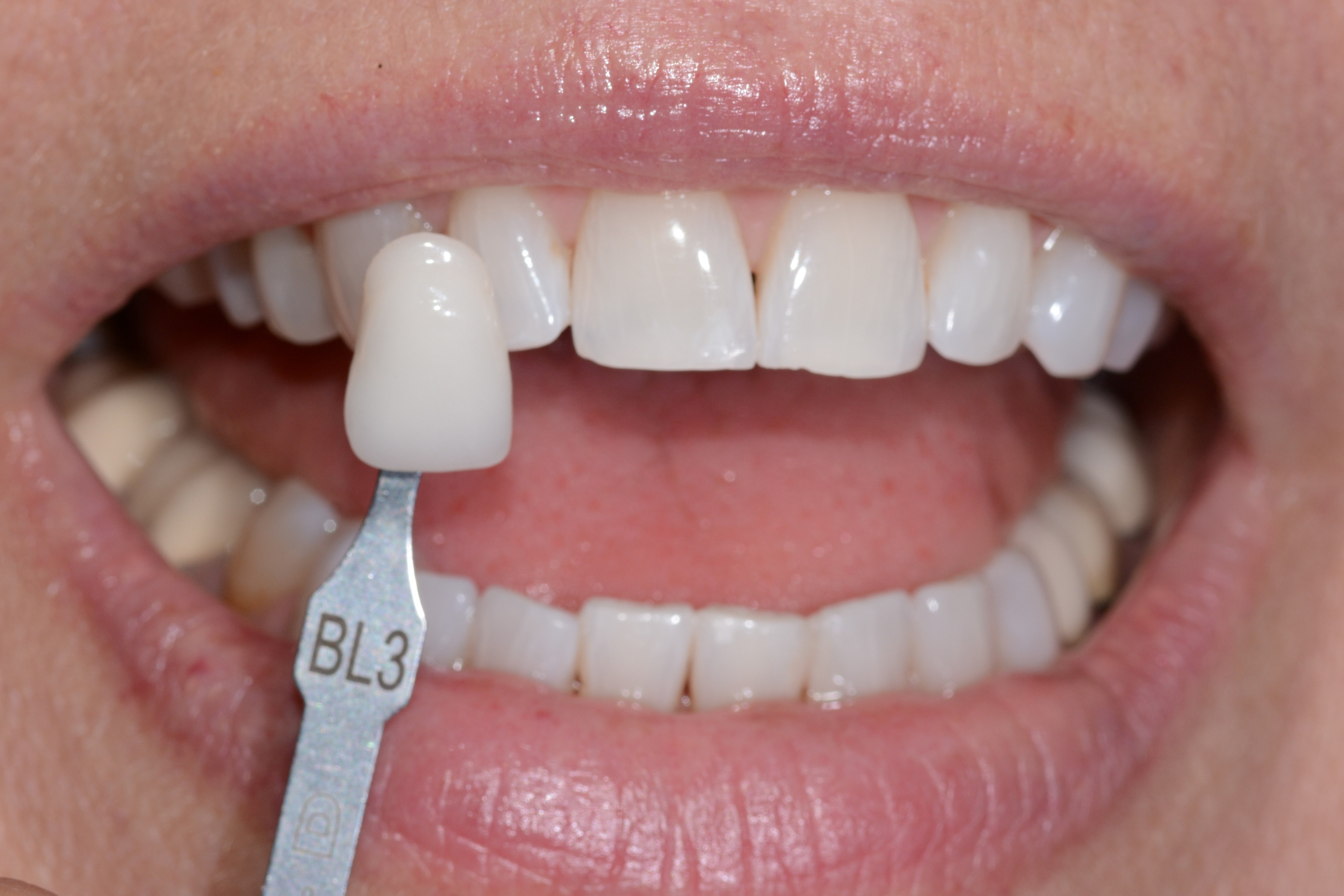 Before and After ZOOM!® Teeth Whitening Photos