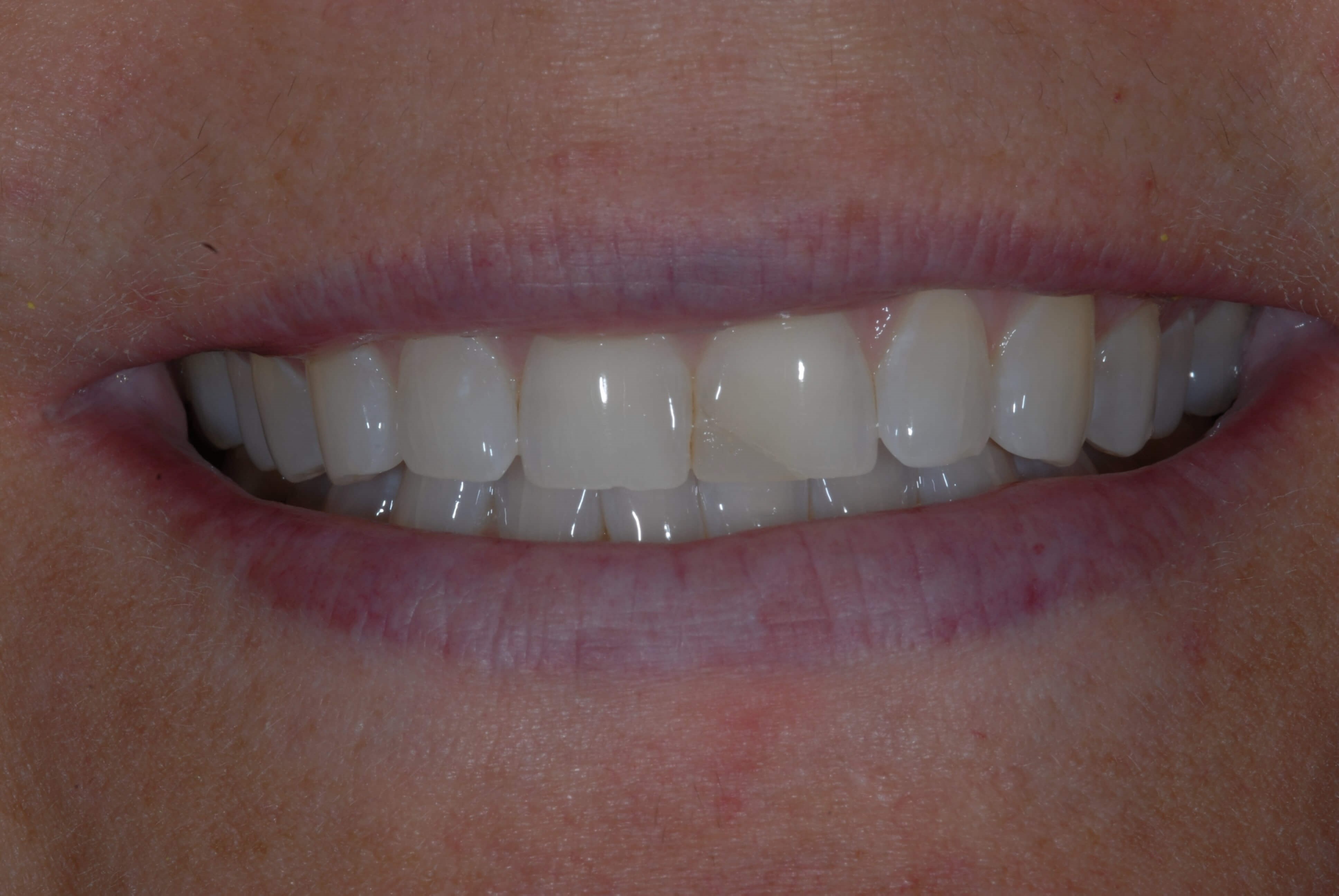 No Prep G Lewis Veneers For Female Patient