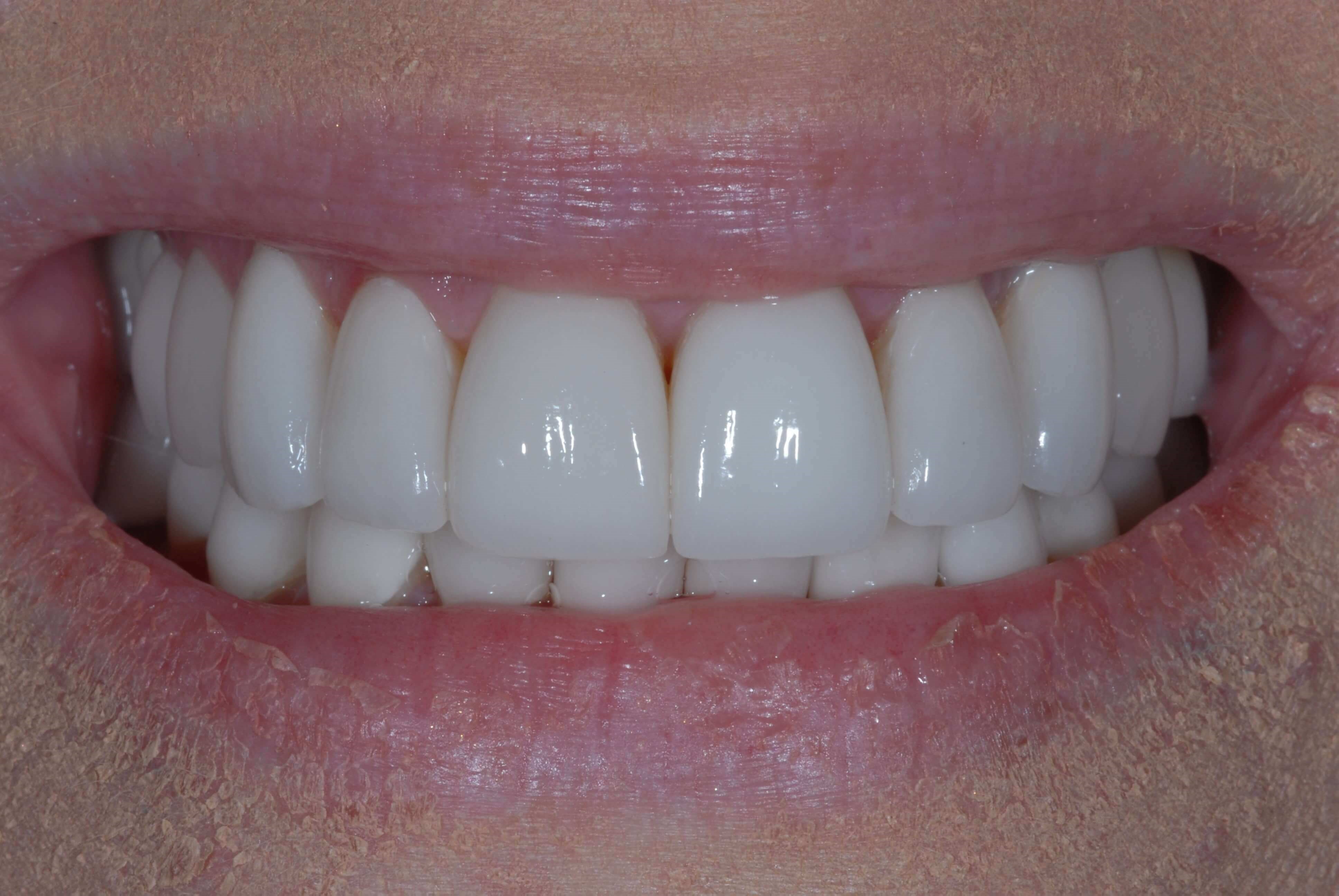 Естественная белизна зубов